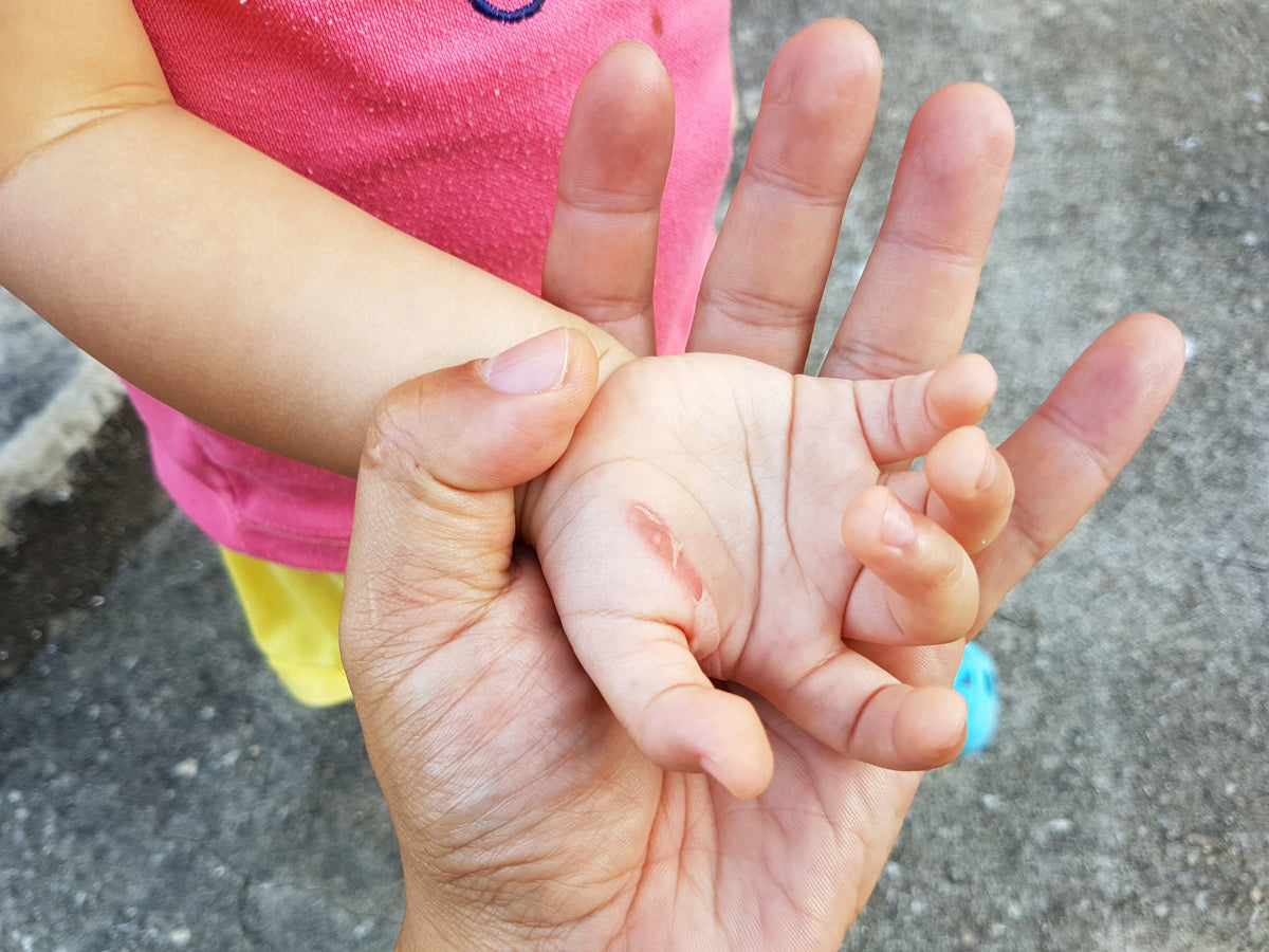 Scar Treatment for Kids: Comprehensive Guide for Effective Healing