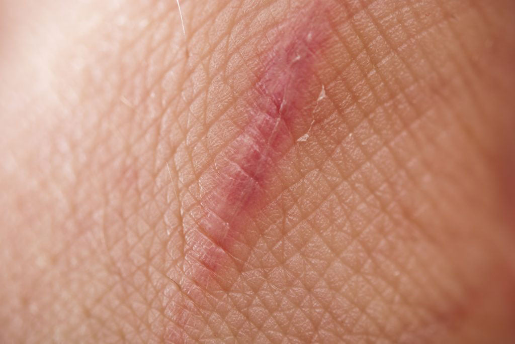 10 Facts About Scarring That Will Blow Your Mind
