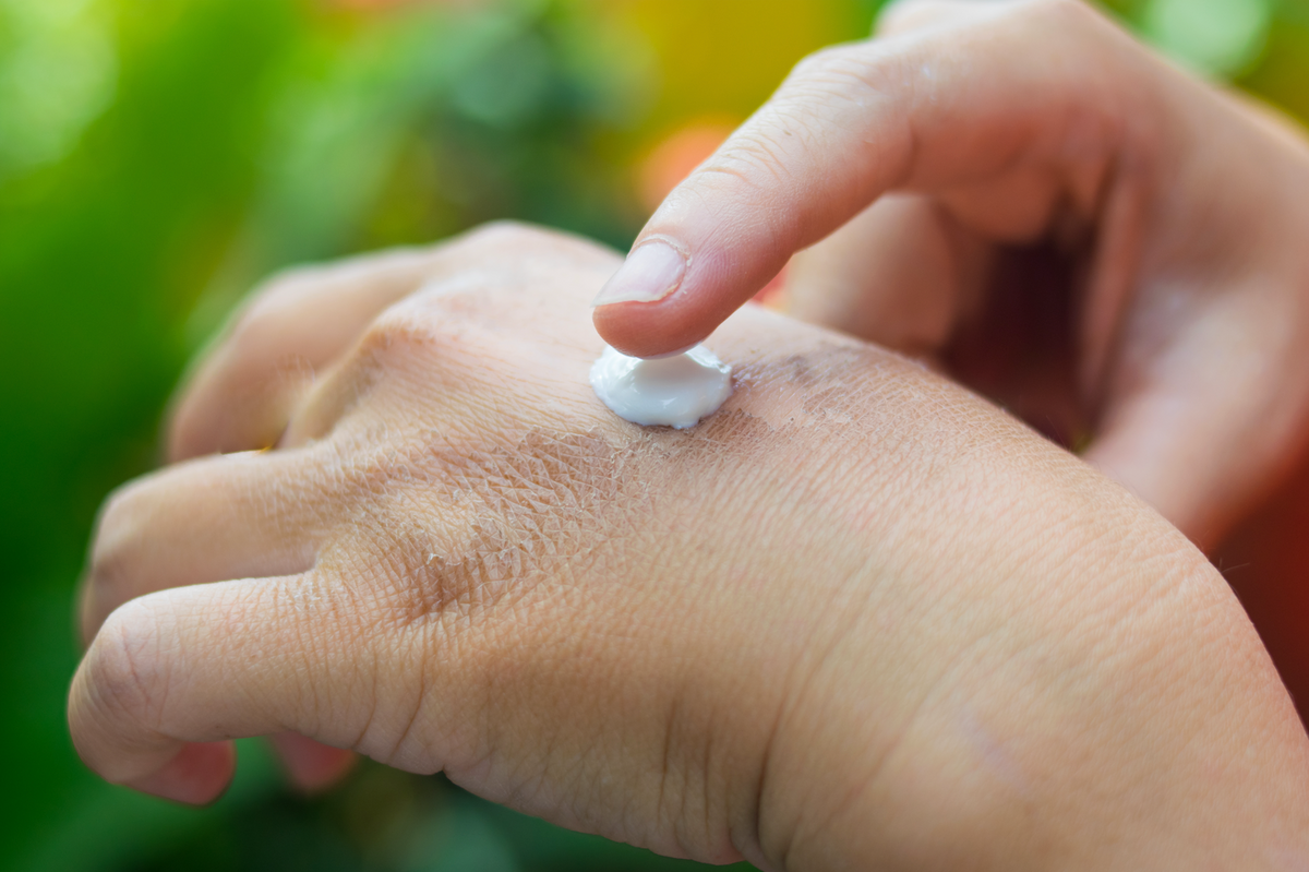 How to Treat Scars Caused by Burns Rejuvaskin Rejûvaskin