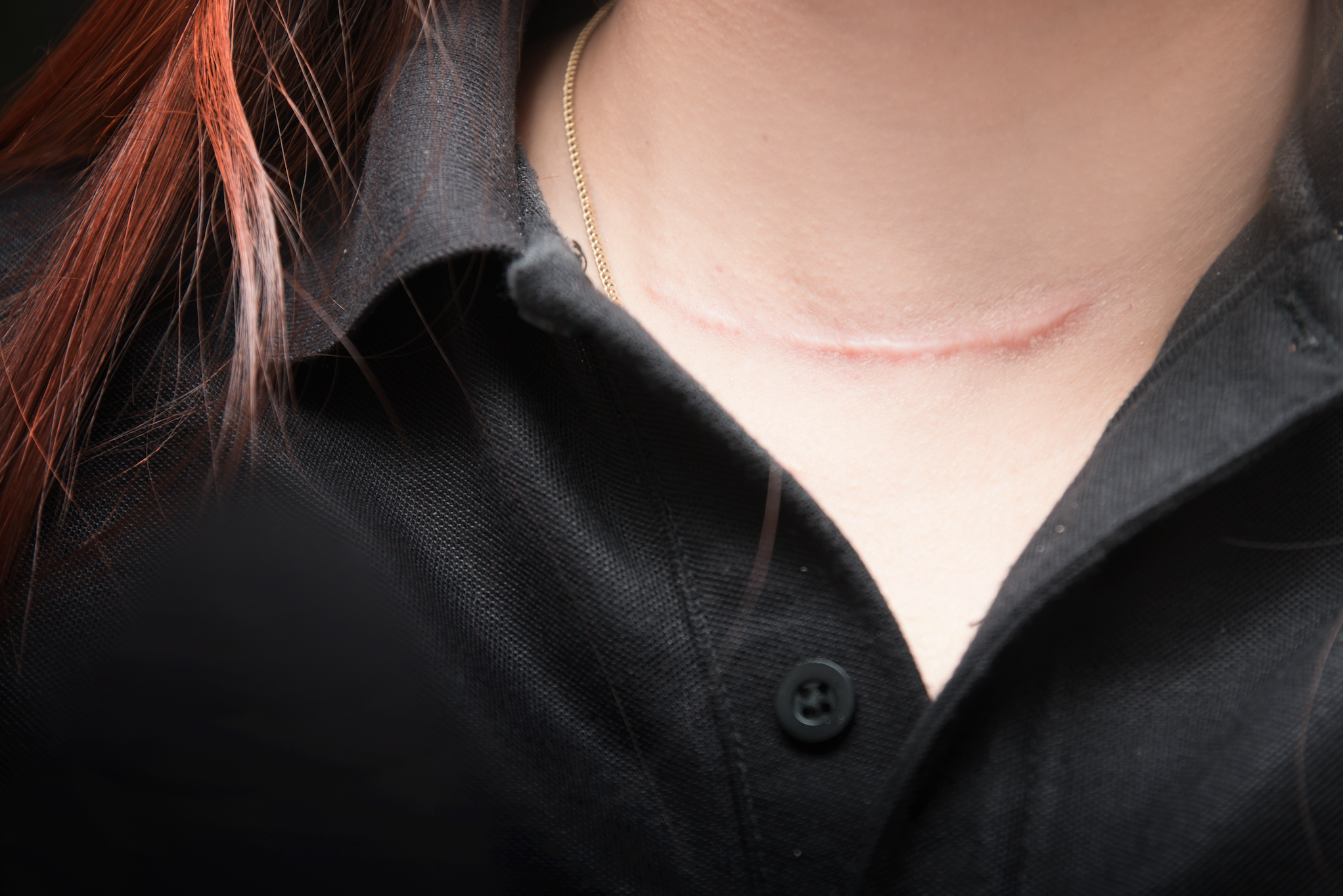 Being Ready For Thyroid Surgery Recovery: What To Expect