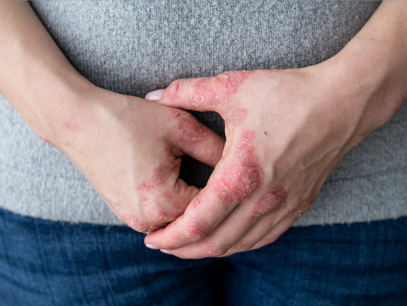 Flare Up vs TSW: How To Tell The Difference | what does the start of TSW look like, TSW symptoms, how to treat eczema flare ups