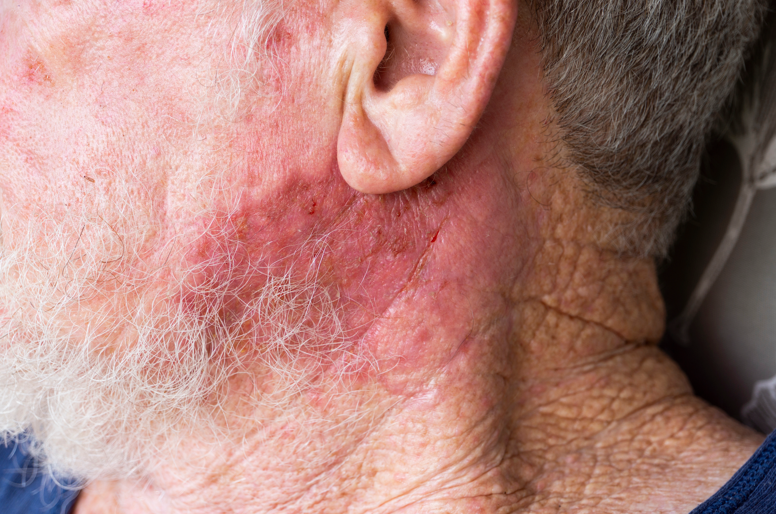 What Are Radiation Burns? || radiation burn symptoms, how long does it take radiation burns to heal, best cream for radiation burns