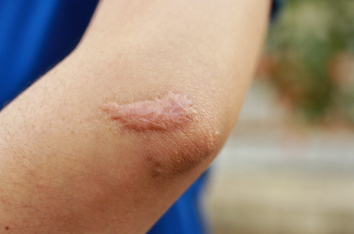 Why Do Some People Scar More Than Others? || what causes scarring, what skin types scar easily, how to prevent scarring