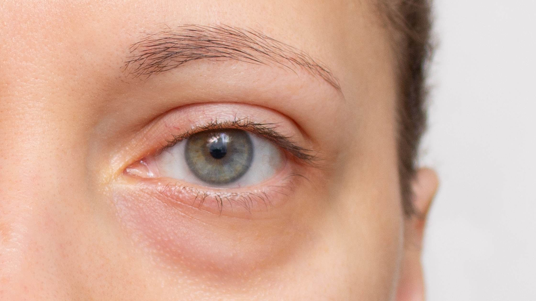 Dark Circles 101: What Causes Them and How to Actually Reduce Them