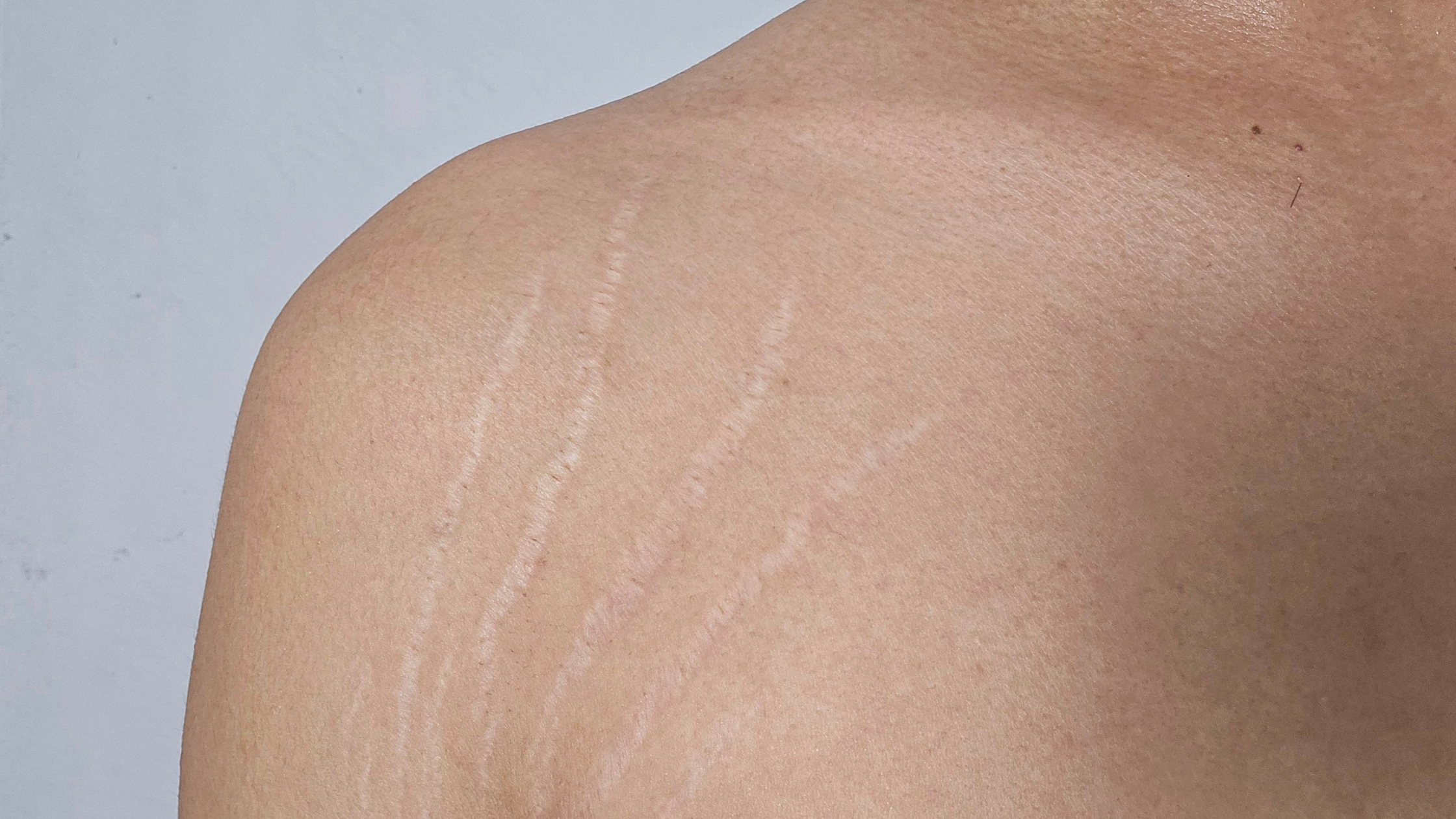 Your 90-Day Plan to Fade Stretch Marks: A Week-by-Week Routine for Visible Improvement