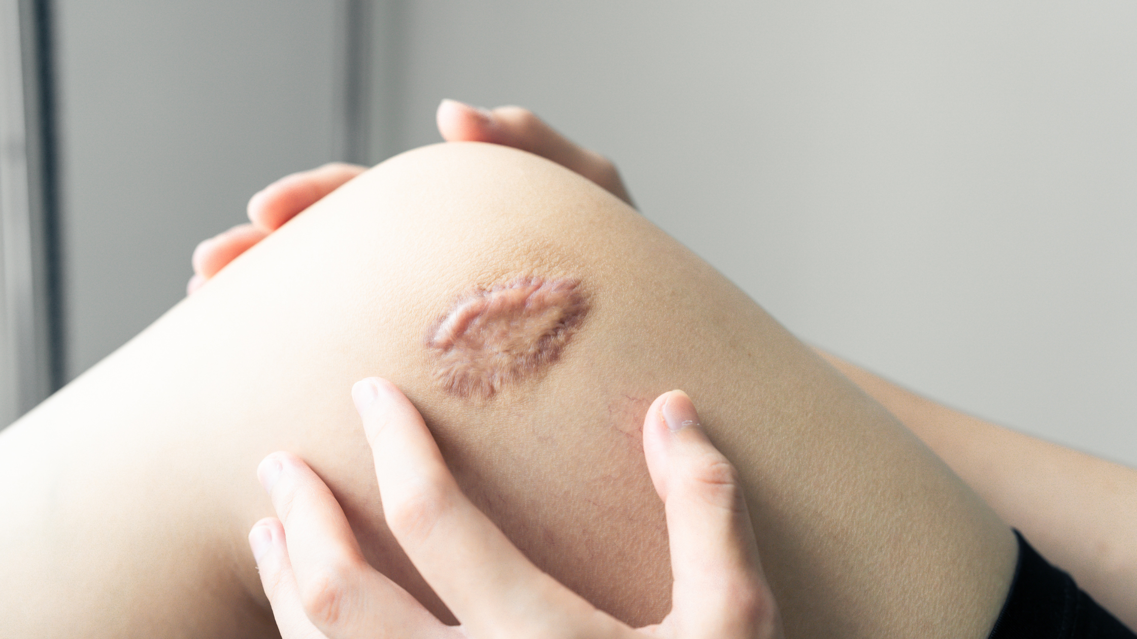 How to Flatten Keloid Scars Naturally — Plus Why Silicone Gel Is the Gold‑Standard