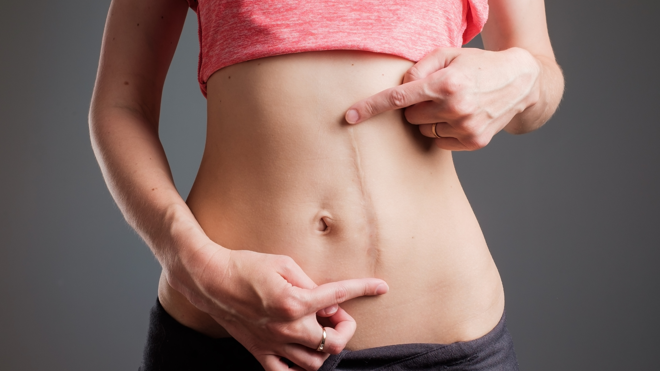 Vaseline vs. Scar Gel: Which Works Better for Healing Scars?