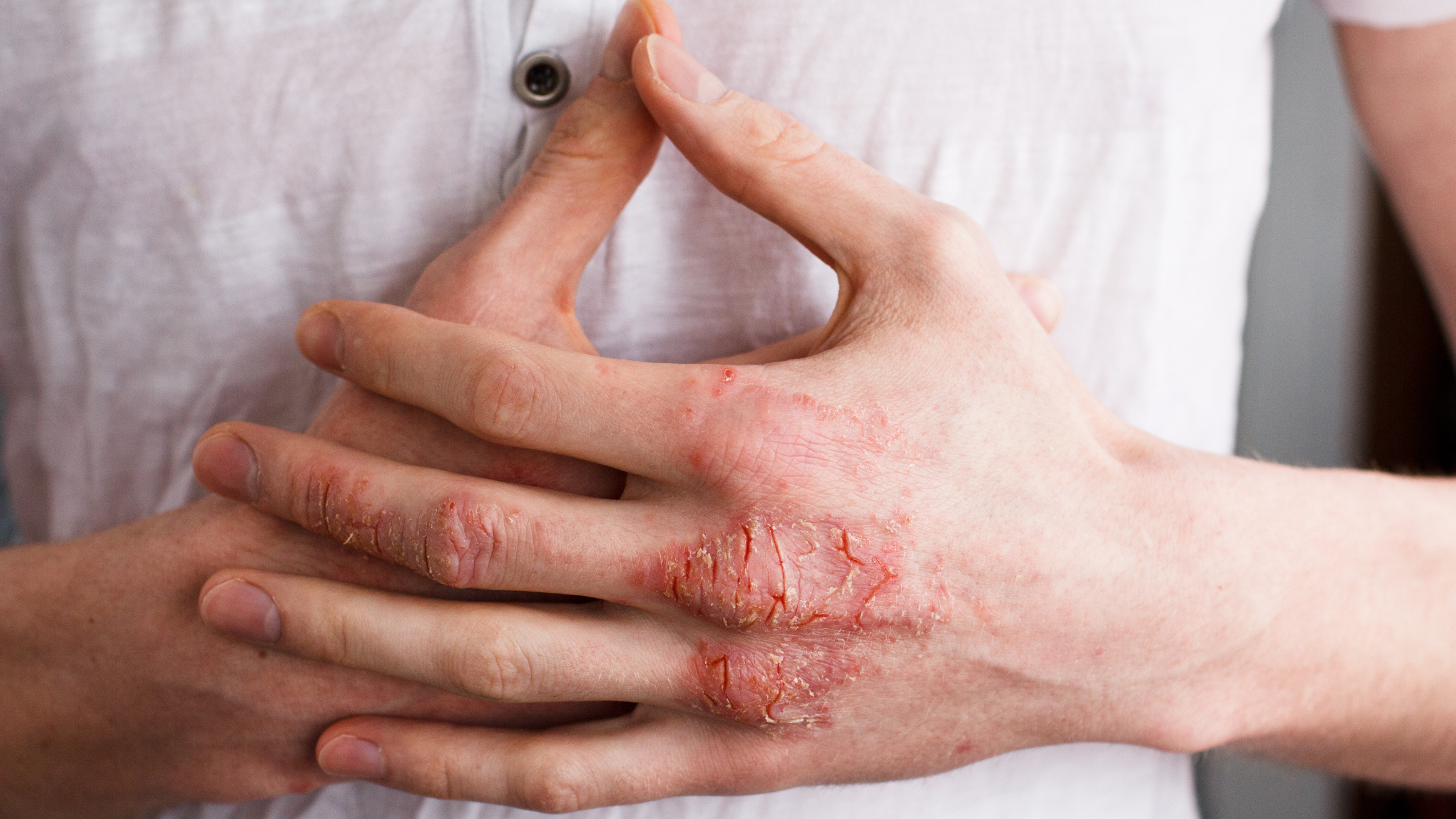 Exploring Eczema Varieties