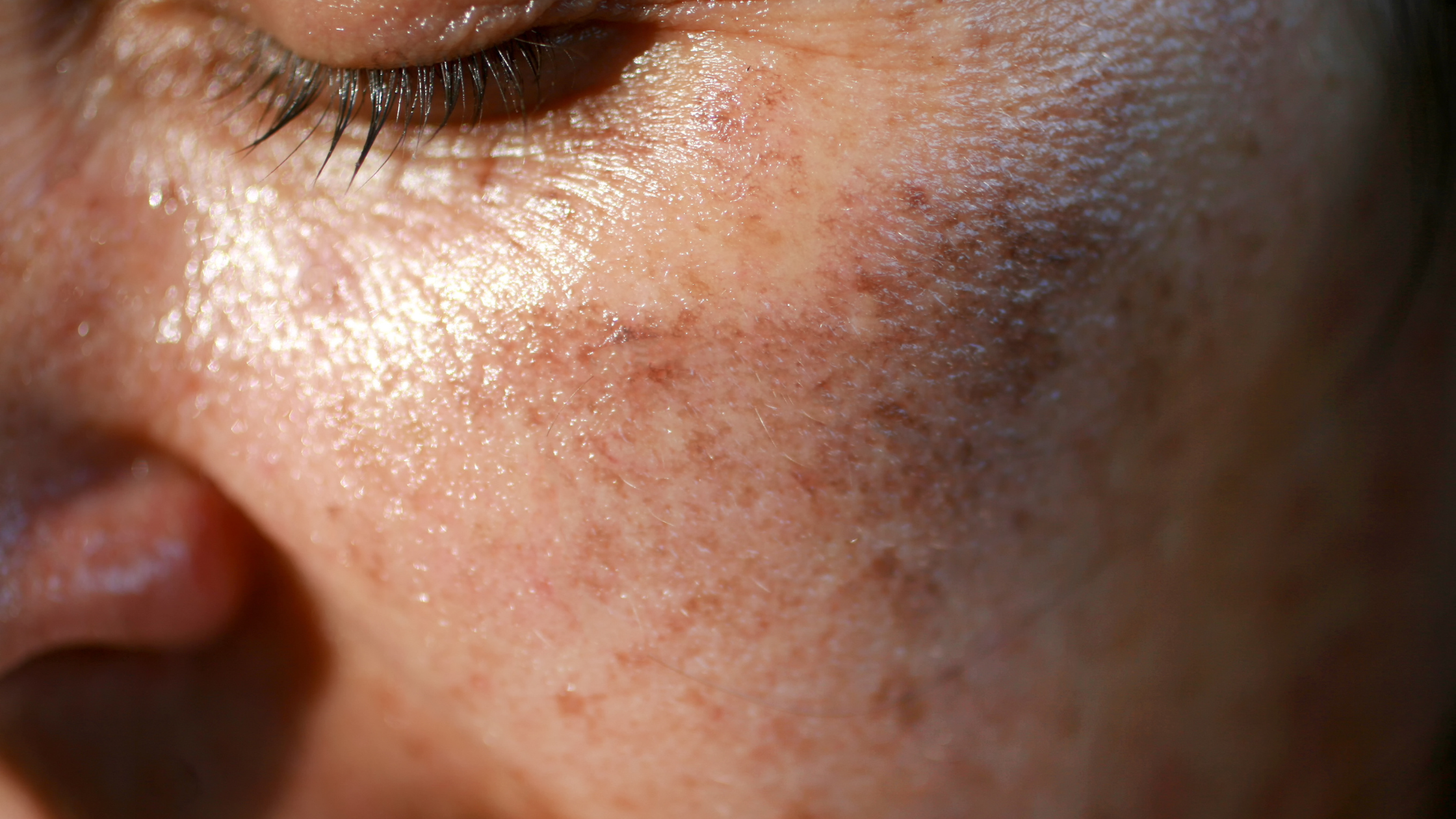 Beyond the Burn: Long-Term Effects of Sun Exposure on Skin Health