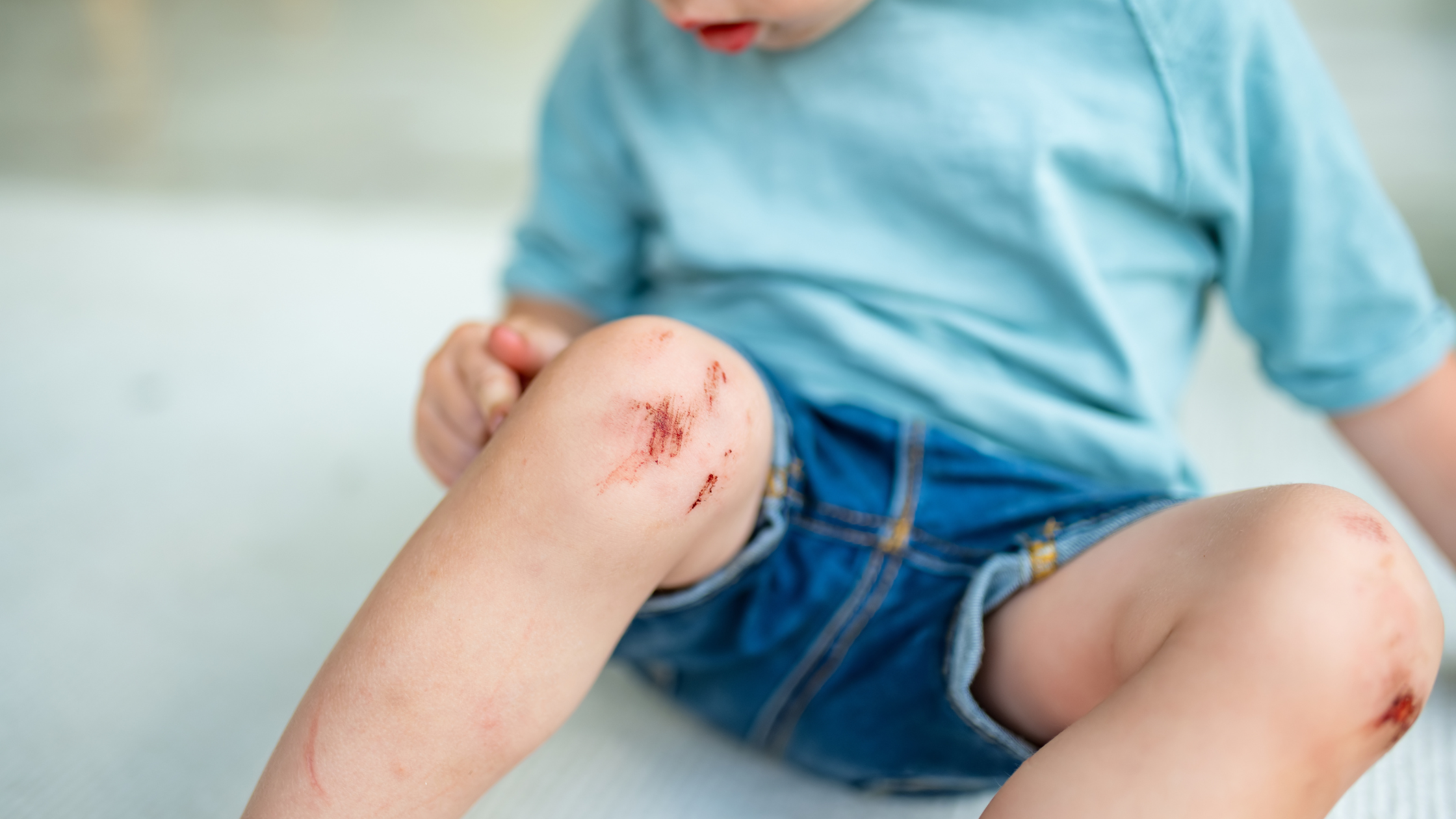 Scar prevention after common childhood injuries (scrapes, bites, falls)
