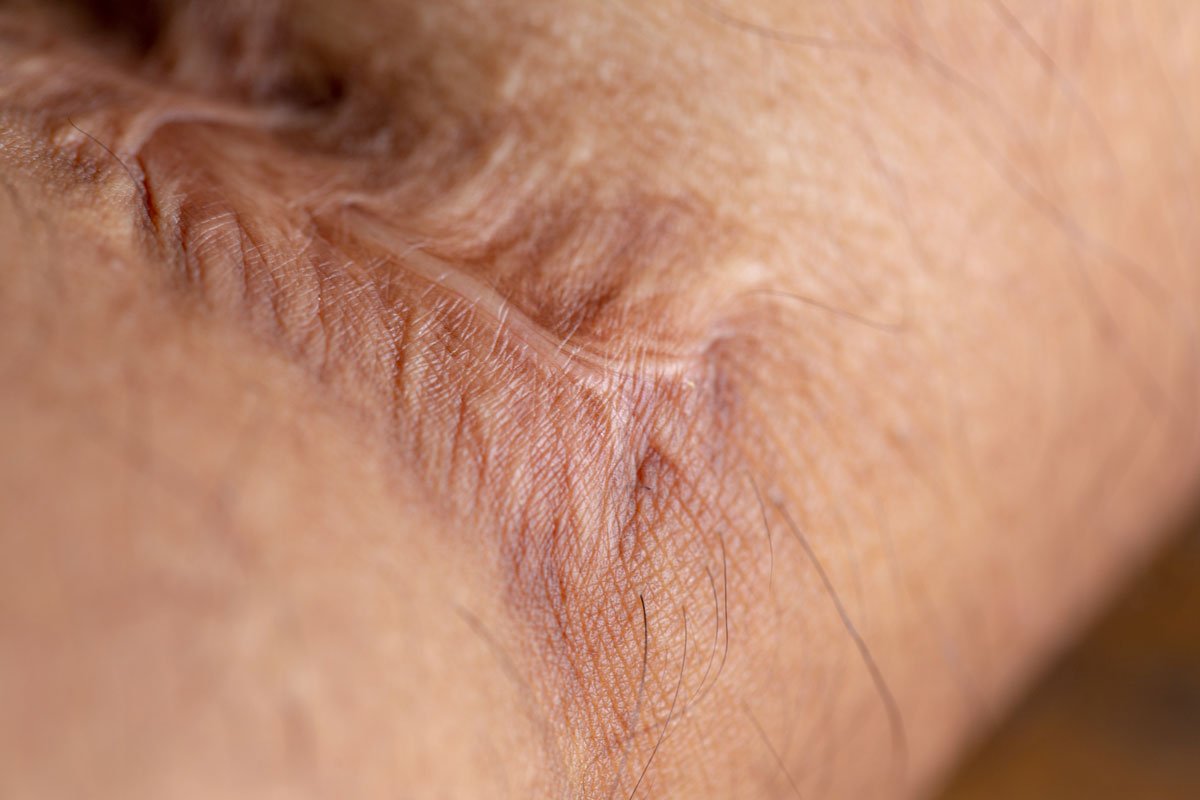 Keloid and Hypertrophic Scars: Breaking Down the Difference