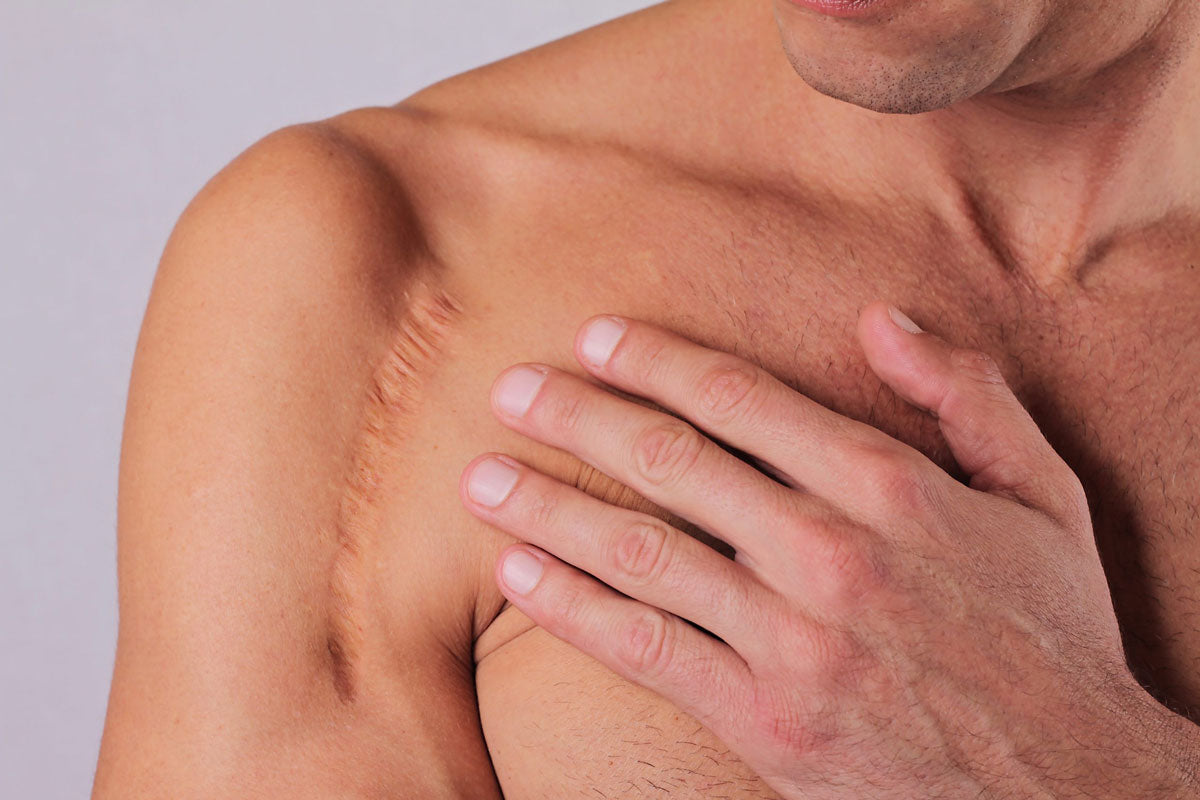 3 Types of Scars & How To Treat Them