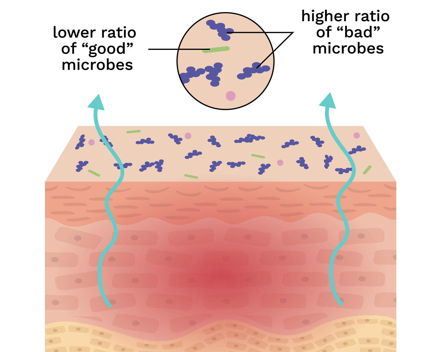 Diagram showing the disrupted microbiome that occurs with eczema