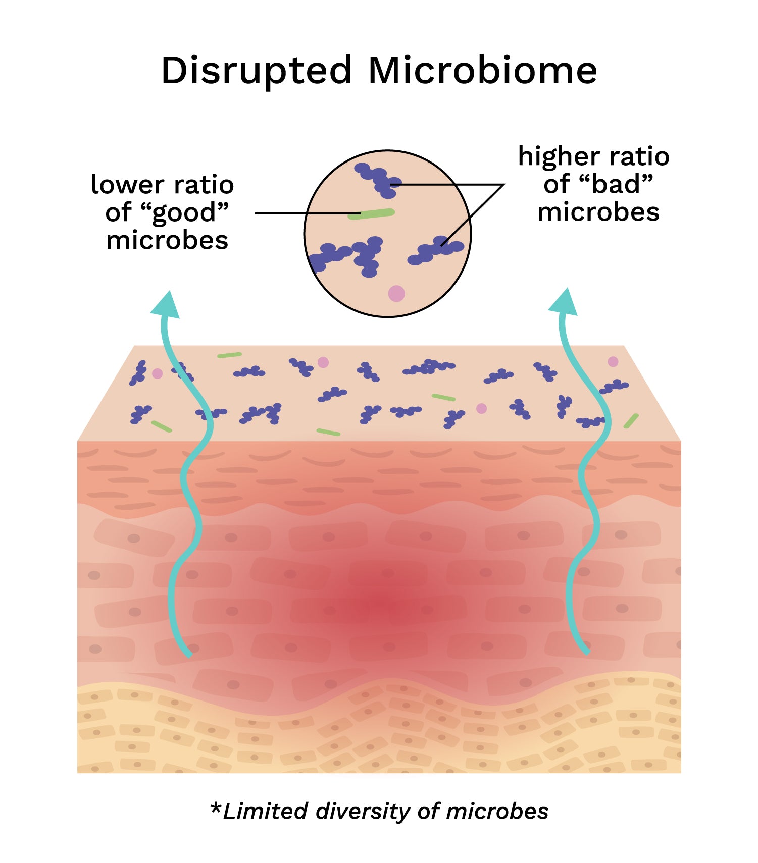 Diagram showing the disrupted microbiome that occurs with eczema
