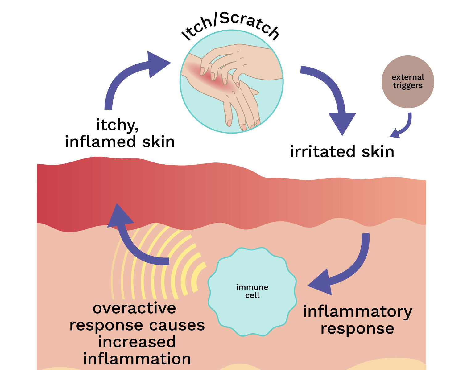 Diagram showing how eczema's itch/scratch cycle stems from an overactive immune response increasing inflammation in skin