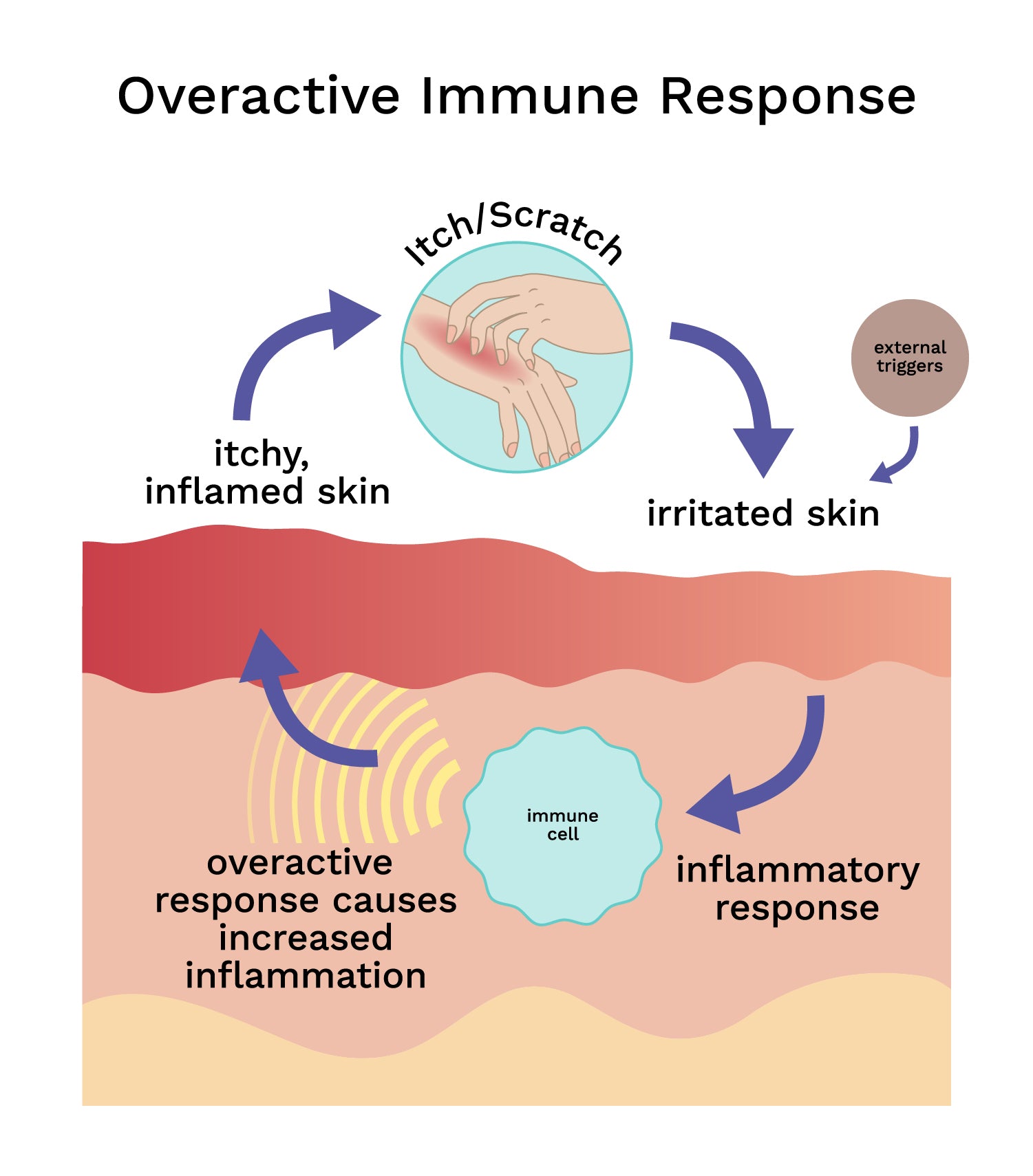 Diagram showing how eczema's itch/scratch cycle stems from an overactive immune response increasing inflammation in skin