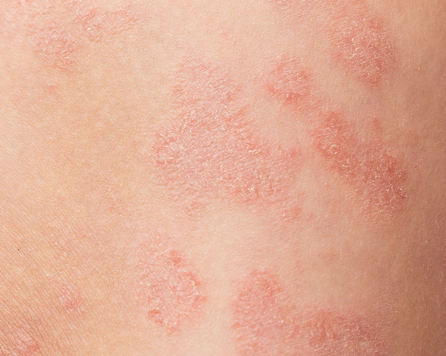 Close-up photo of extremely raw, dry skin from an active eczema flare-up, showing characteristic redness and irritation