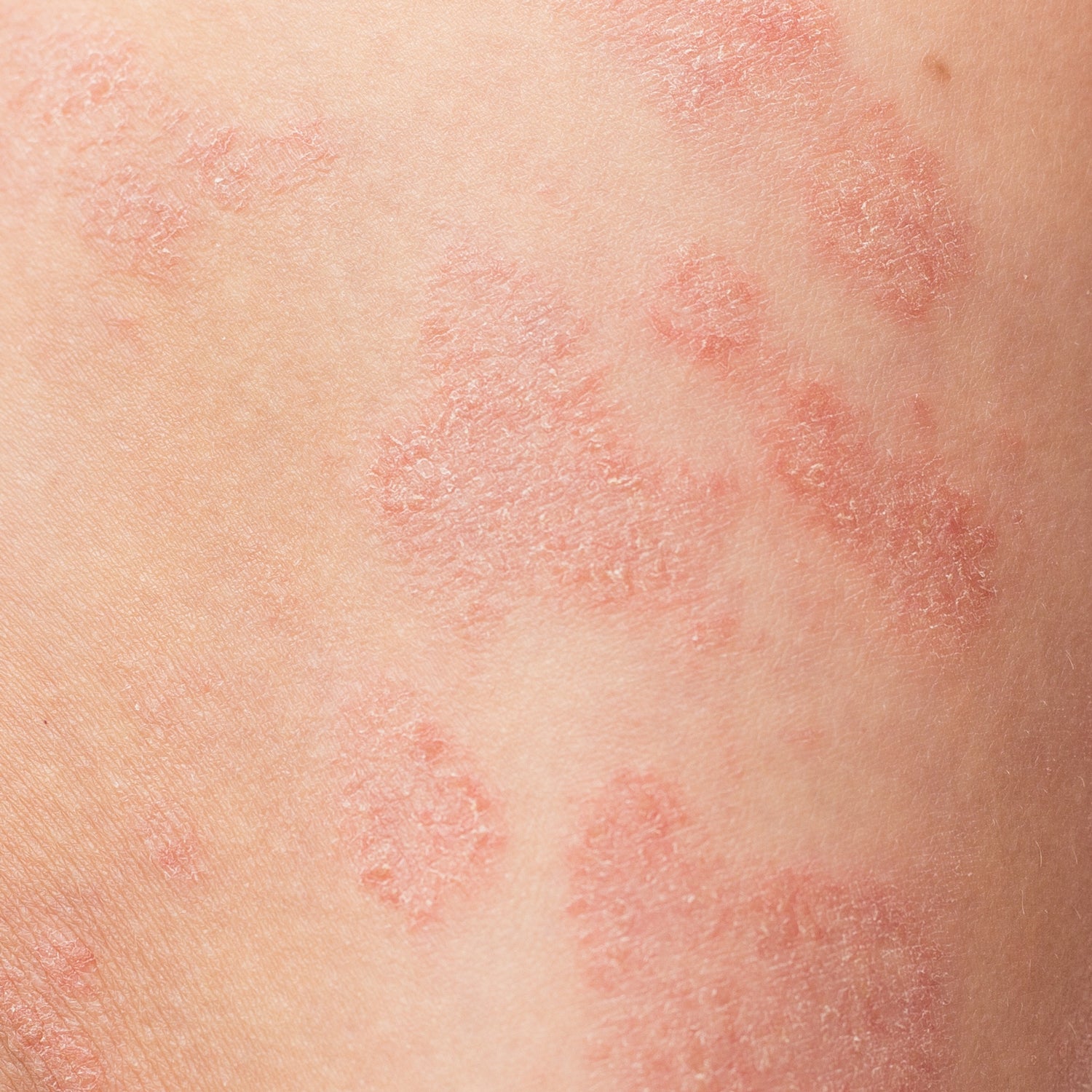 Close-up photo of extremely raw, dry skin from an active eczema flare-up, showing characteristic redness and irritation