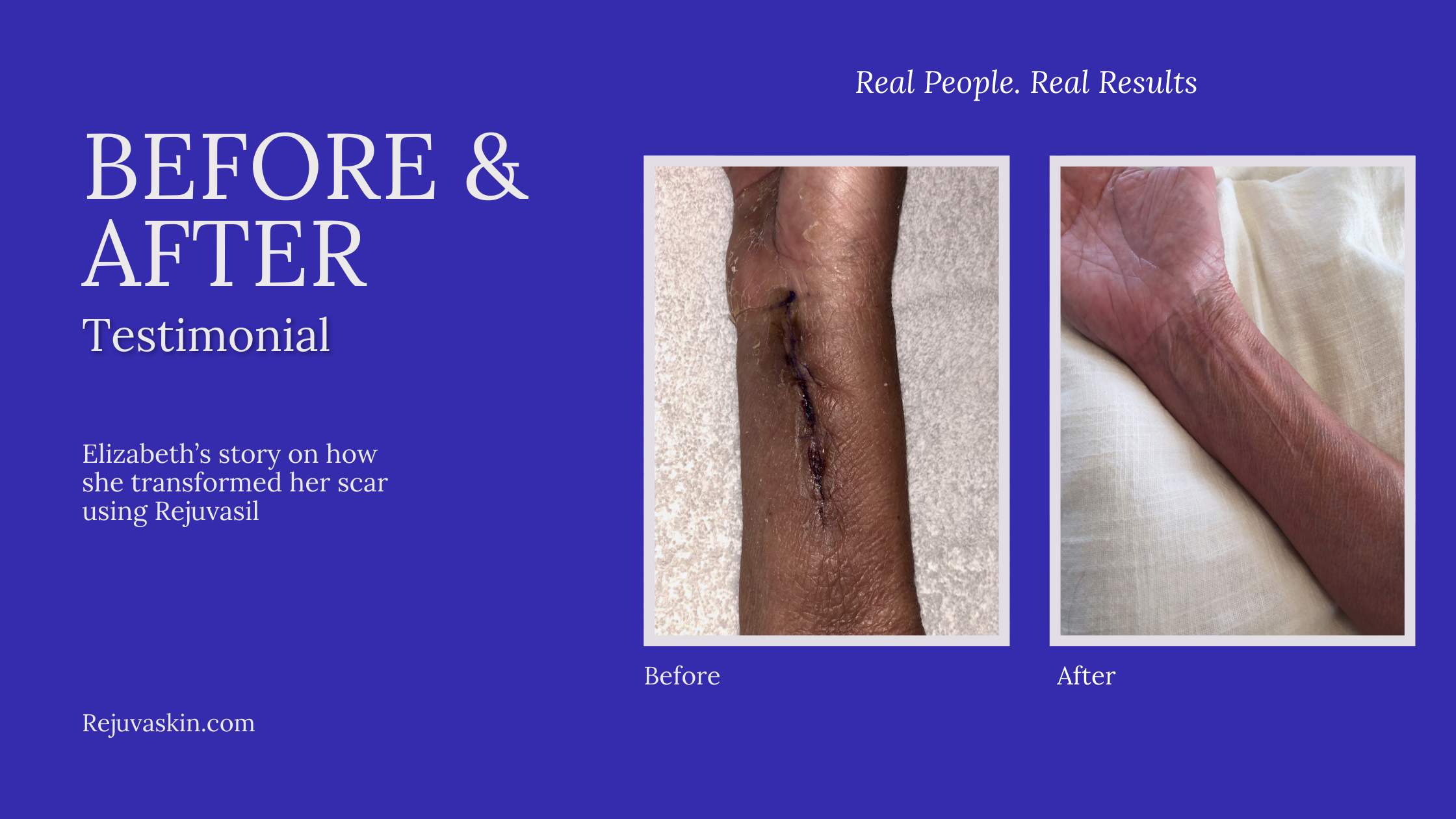 “This Product Puts Its Money Where Its Mouth Is” — Elizabeth’s Journey with RejuvaSil® Silicone Scar Gel