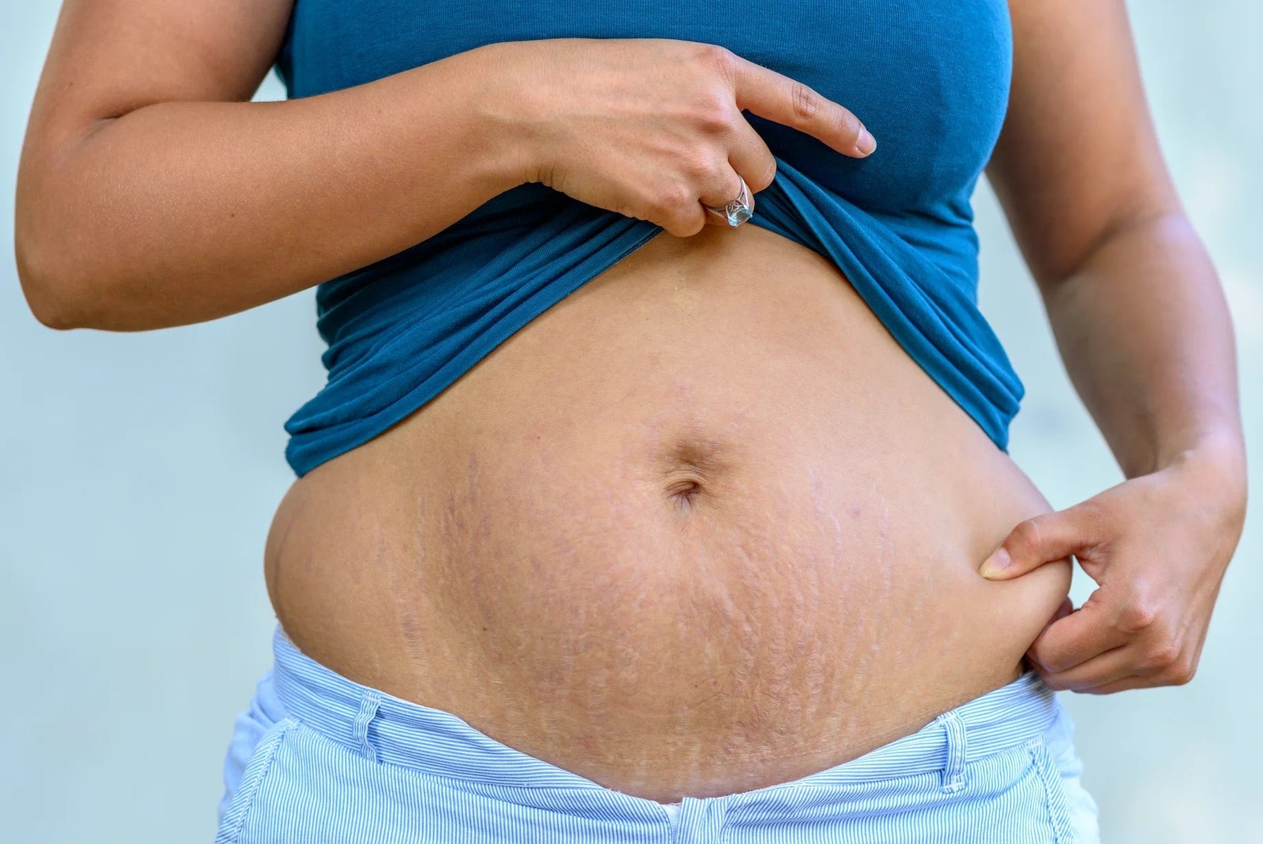 What Are the Types of Stretch Marks?