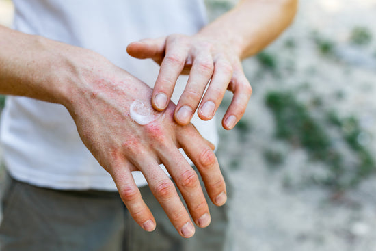 5 Things You Probably Didn’t Know About Eczema
