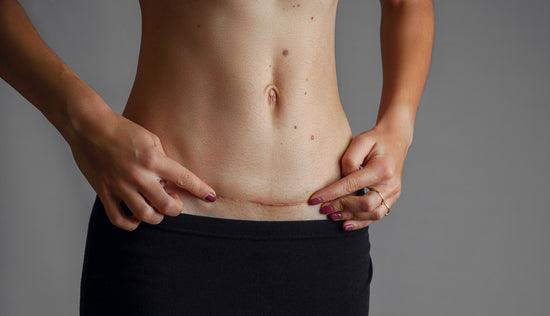 How To Pick The Best Scar Product For Your Needs