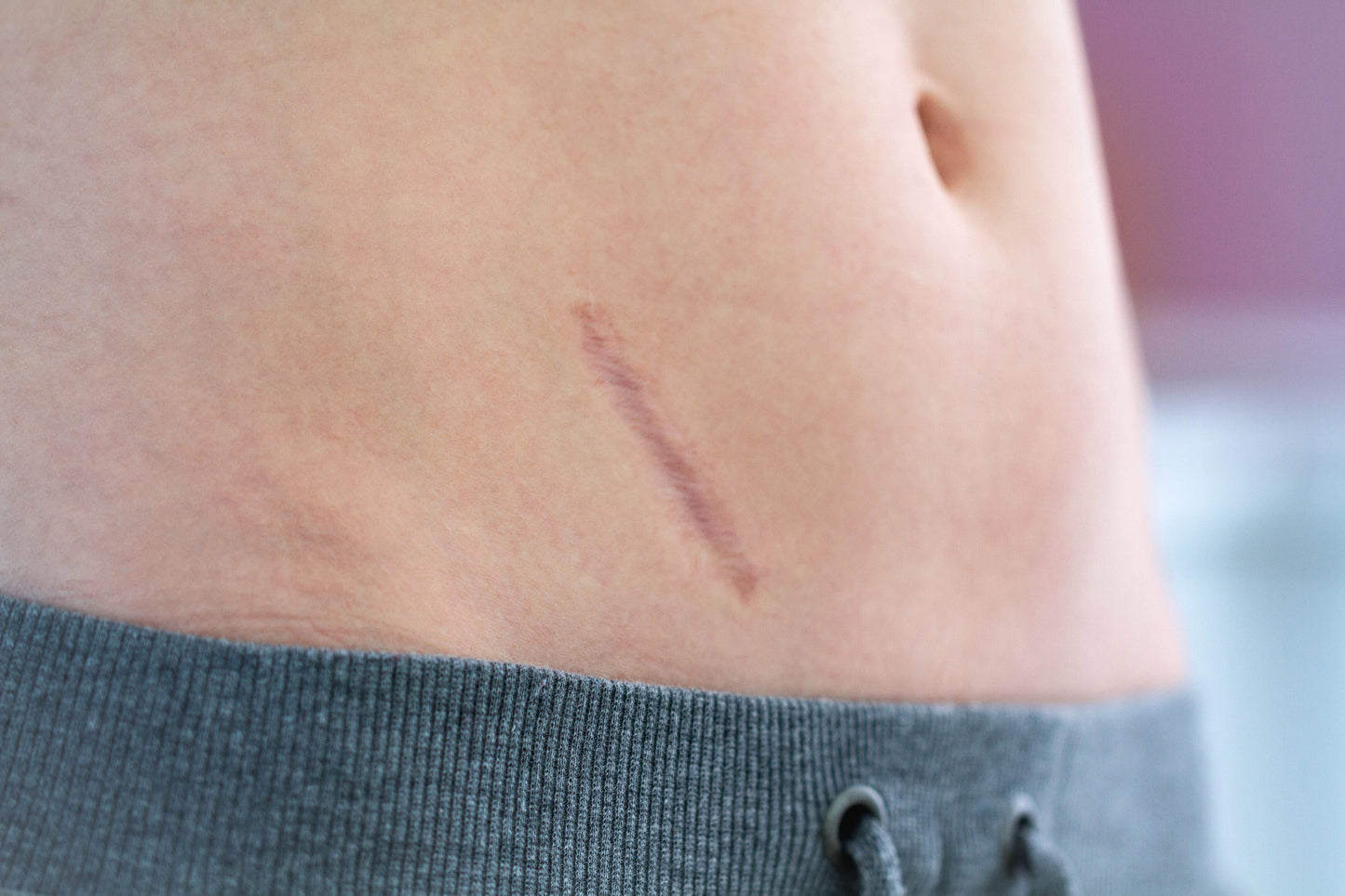 What Your Patients Need to Minimize a Scar in 2022
