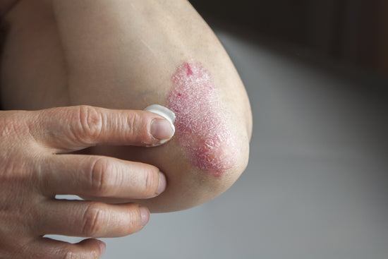 The Most Common Eczema Areas