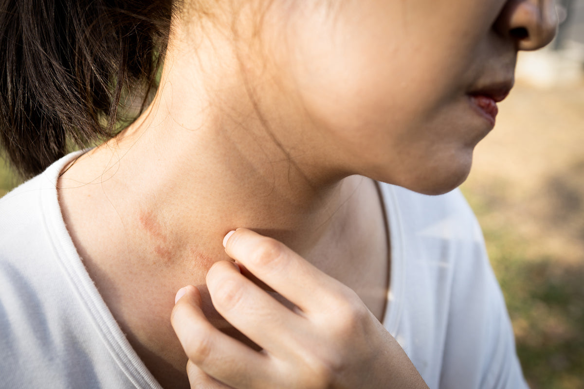 5 Things Your Patients May Not Know About Eczema