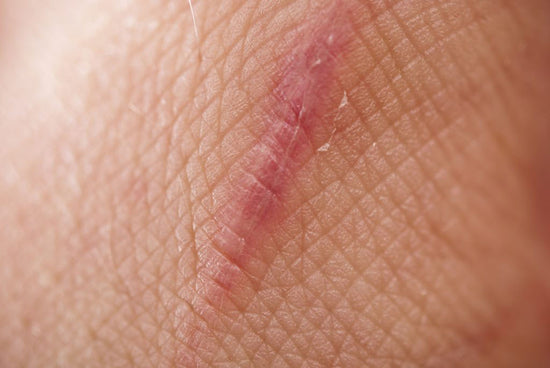 10 Facts About Scarring That Will Blow Your Mind