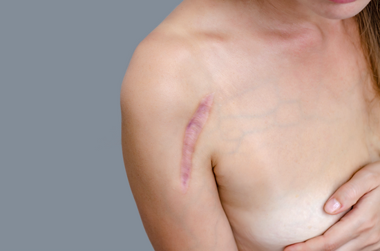 The Features of Scars: What Causes Scar Discoloration, Raised Scars, & More