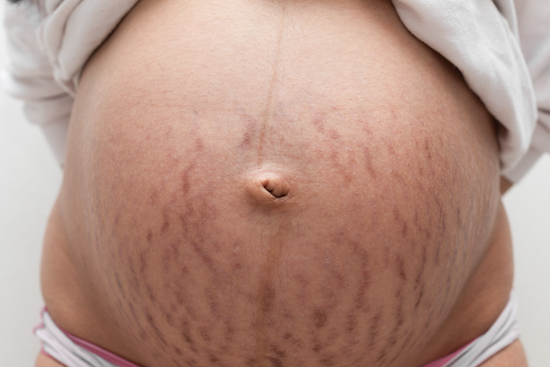 Red vs. White Stretch Marks: What Does The Color of Your Stretch Marks Mean?