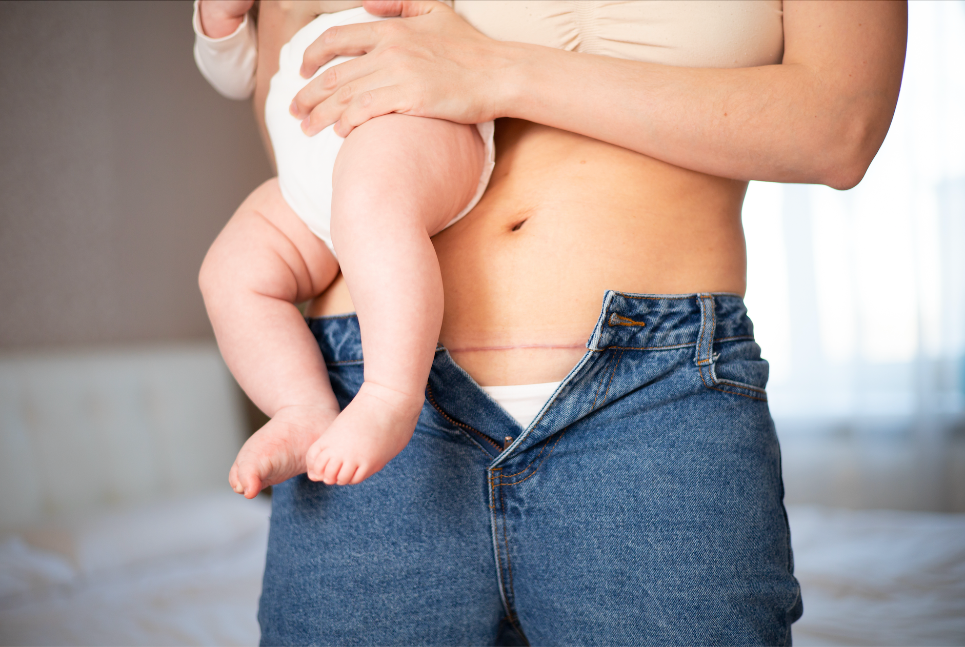 Healing Your C-section Incision — Expecting & Empowered