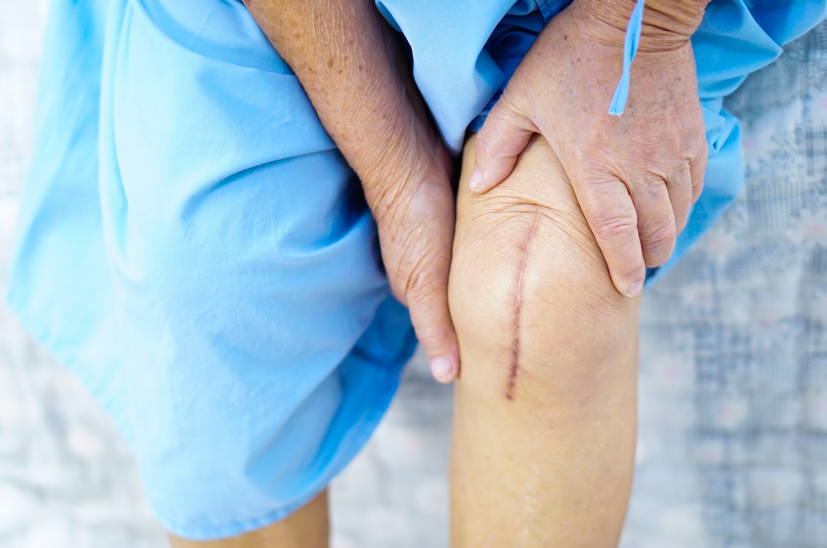 Why Do My Scars Turn Dark? The Basics Behind Scar Discoloration ...