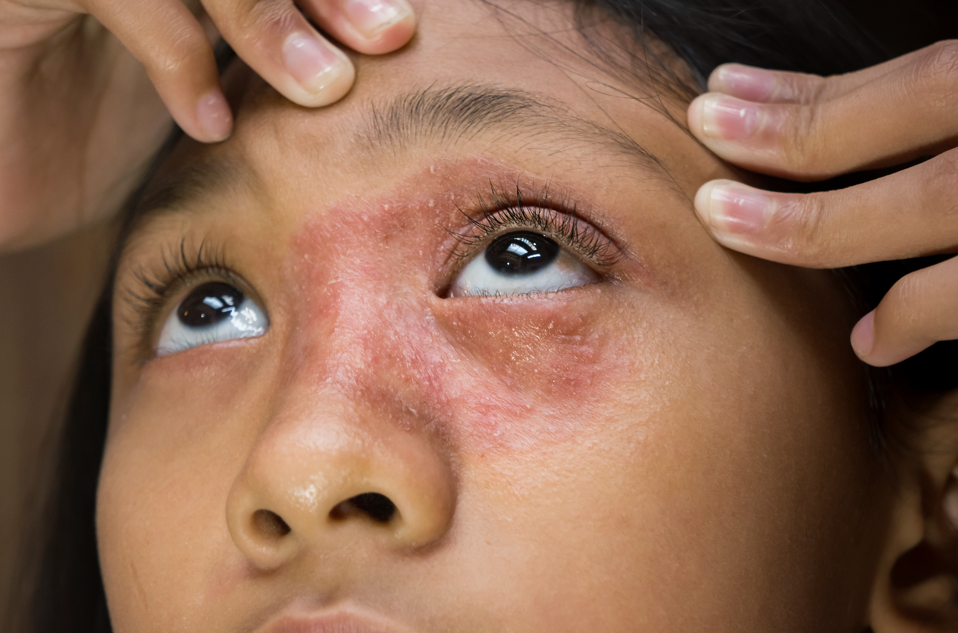 8 Eczema Tips: How To Reduce Your Outbreaks