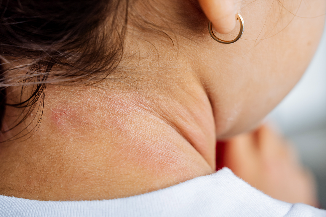 What Is Topical Steroid Withdrawal? The Causes, Symptoms, & Recovery Rejûvaskin