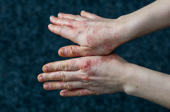 What Are The Types of Eczema?