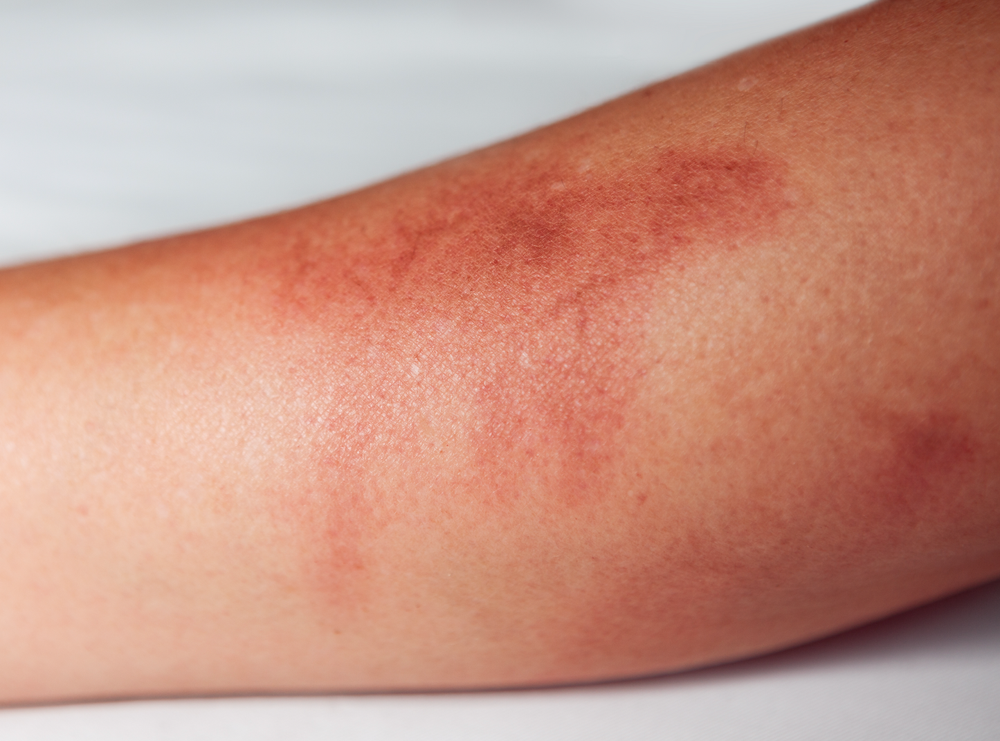 Radiation burns deals