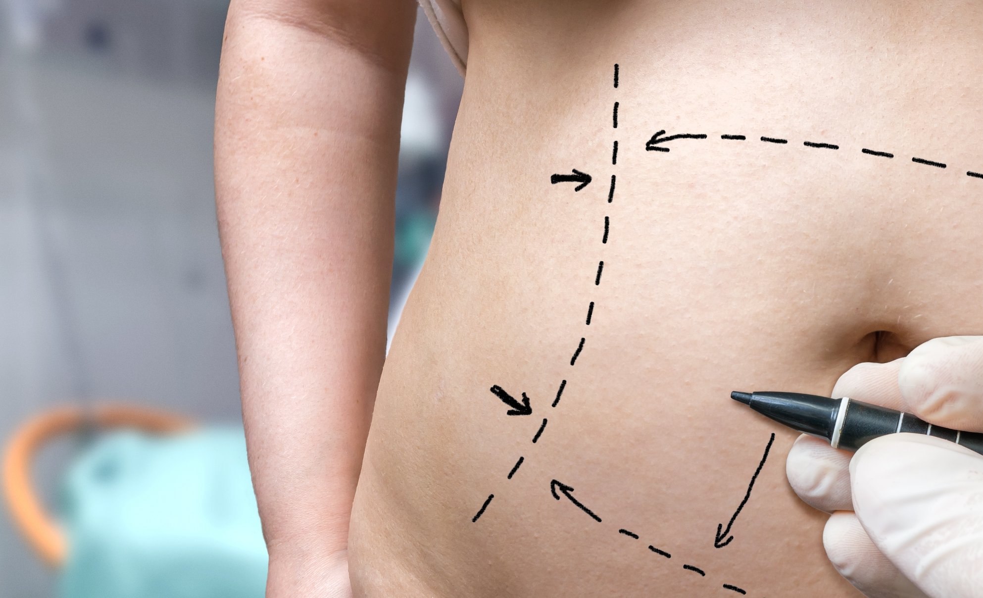 Tummy Tuck Recovery: Get A Glimpse Of The Healing Process