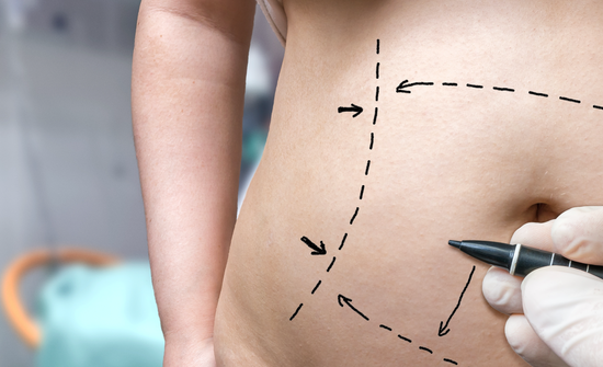 Tummy Tuck Recovery: Get A Glimpse Of The Healing Process