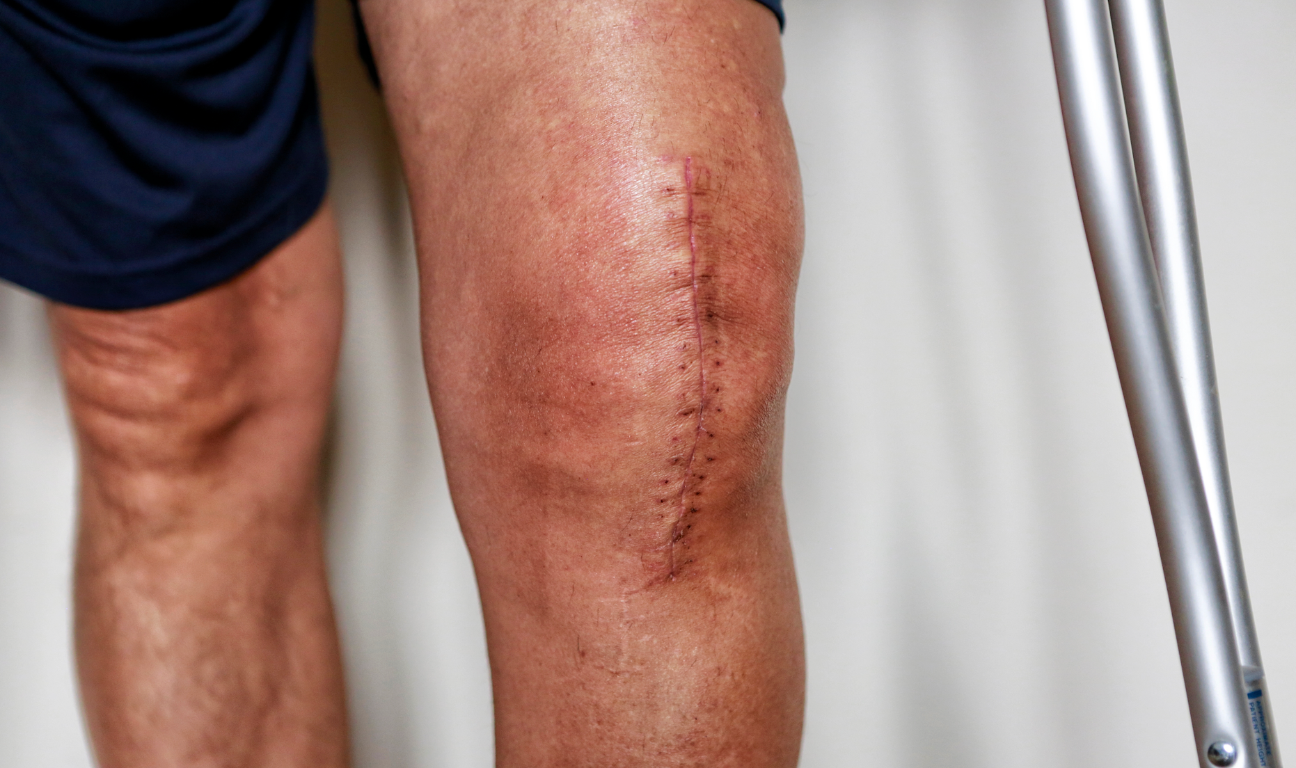 What Are The Most Common Surgical Scars? (And How to Treat Them)