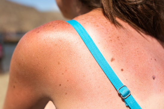 Sun Damage 101: What Do Sunburns Actually Do To Your Skin?