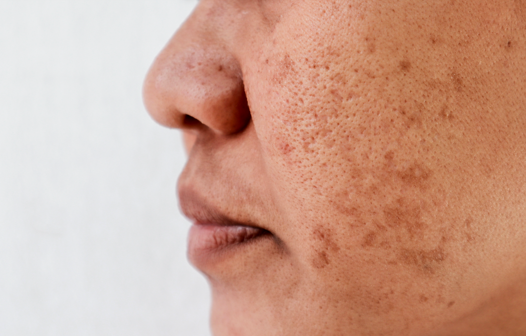 Are Age Spots & Sun Spots One And The Same?