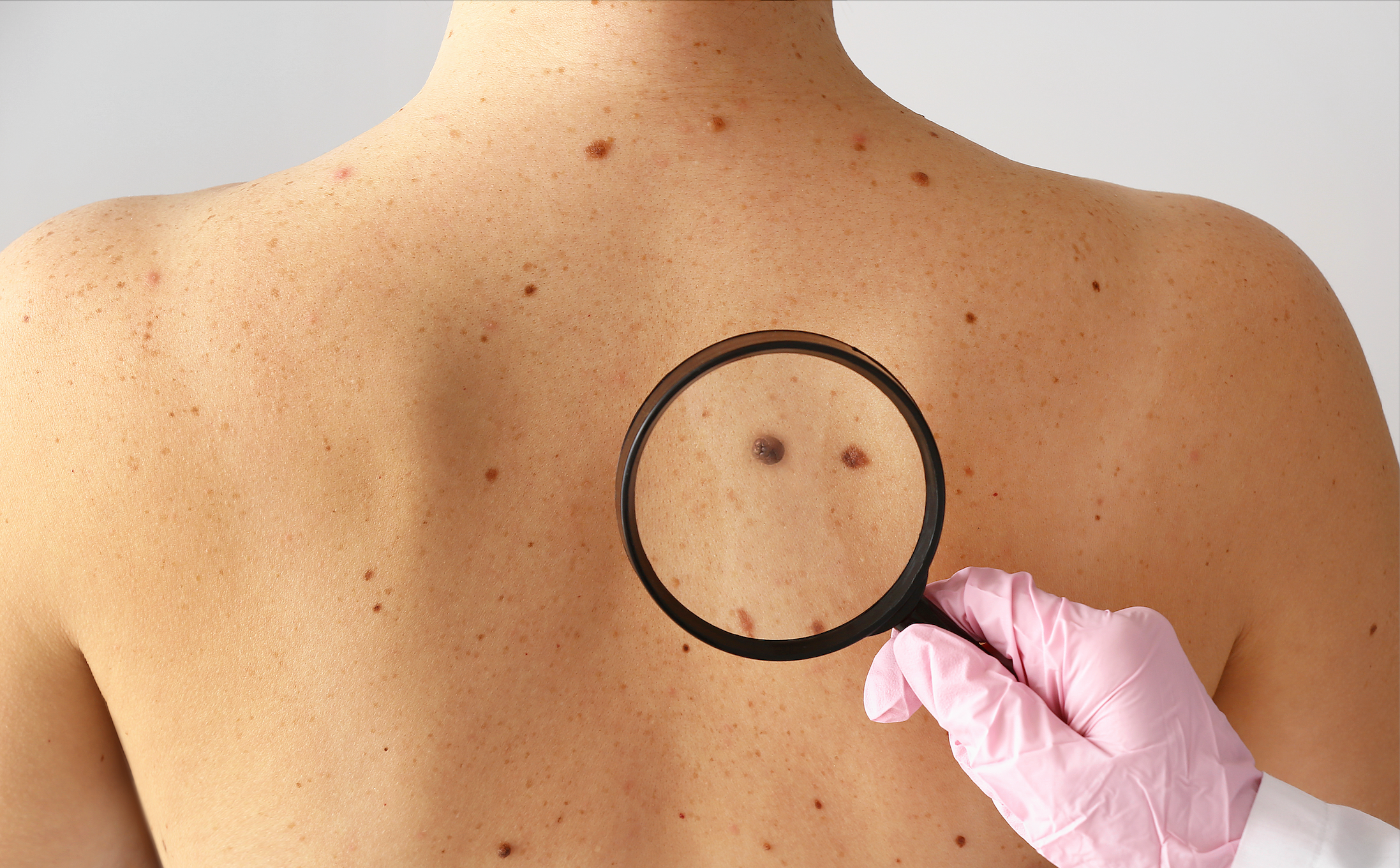 How Is Skin Cancer Treated?