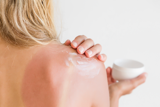 Sunburn FAQs: How To Treat Sunburns || how to treat a sunburn, what not to do after a sunburn, sunburn relief