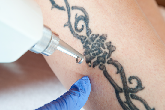 Your Guide To Laser Tattoo Removal Aftercare | what helps laser tattoo removal heal faster, laser tattoo removal cream, tattoo removal aftercare , tattoo cream