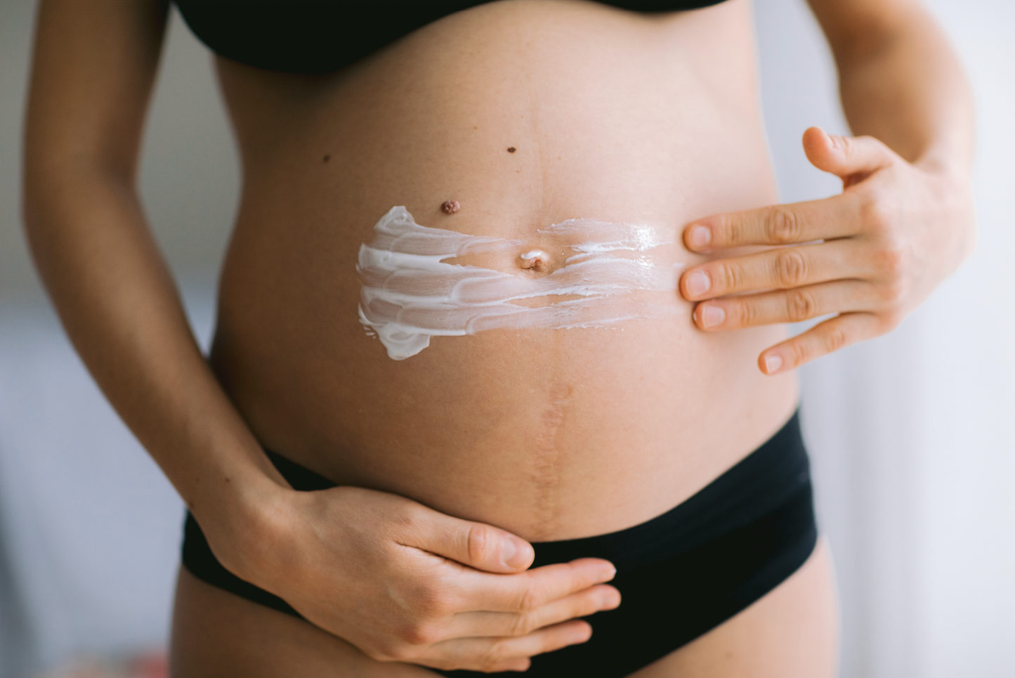How To Prevent Stretch Marks | does moisturizing prevent stretch marks, stretch mark prevention cream, vitamin c for stretch marks