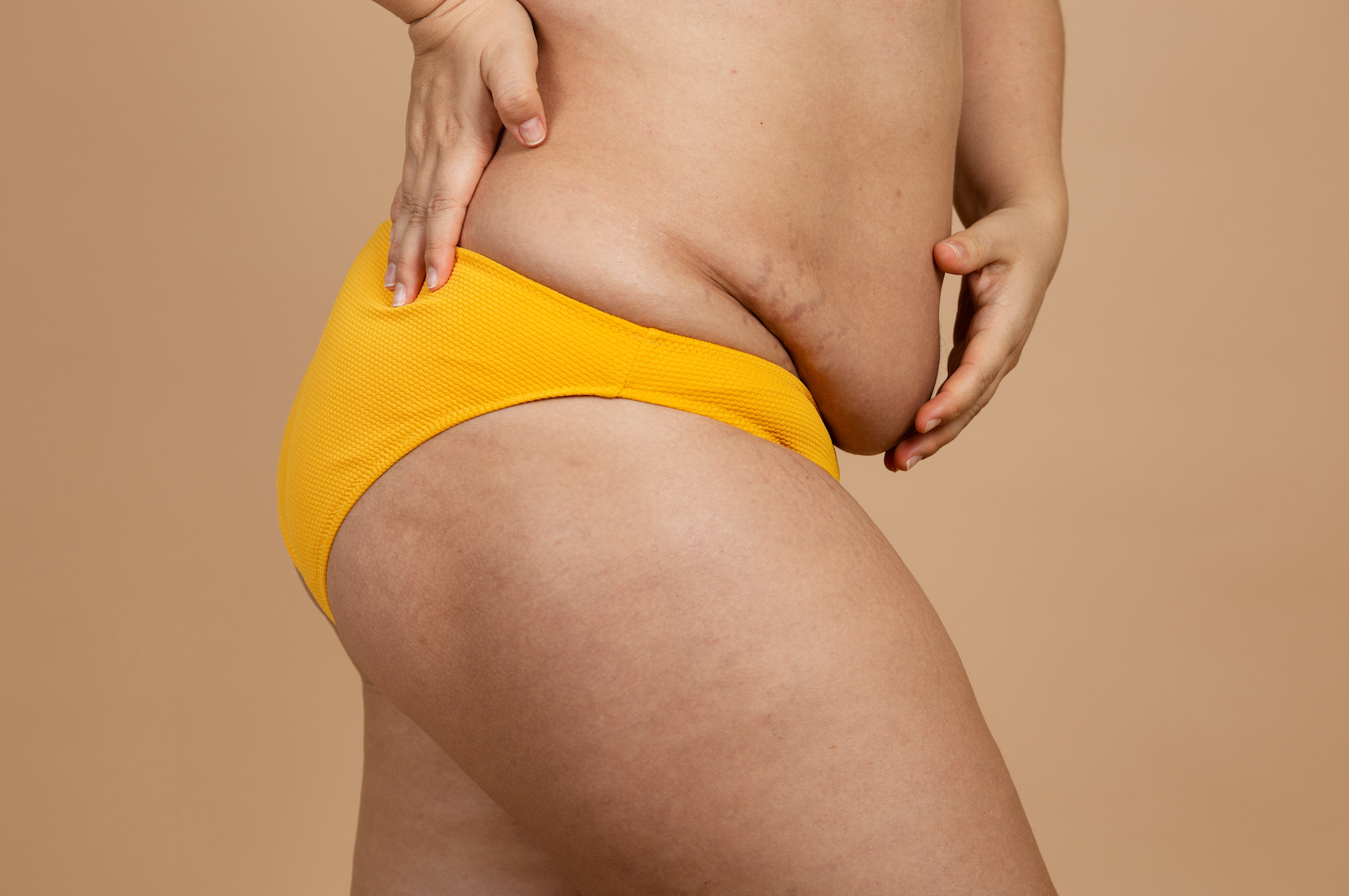 What Is A Tummy Tuck? | what happens during a tummy tuck, stages of a tummy tuck, tummy tuck scar recovery