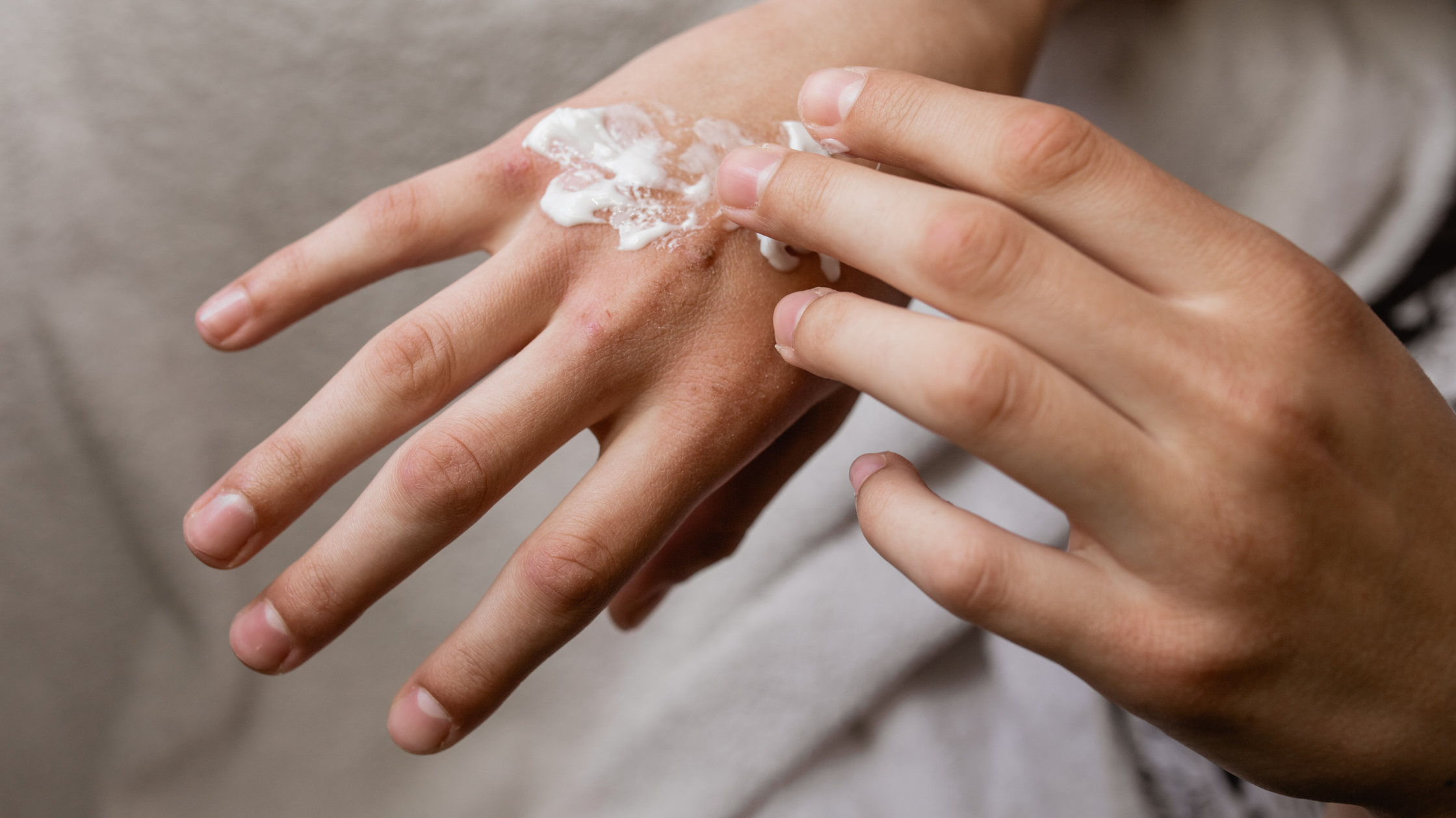 Xerotic (Winter) Eczema: Prevention and Care