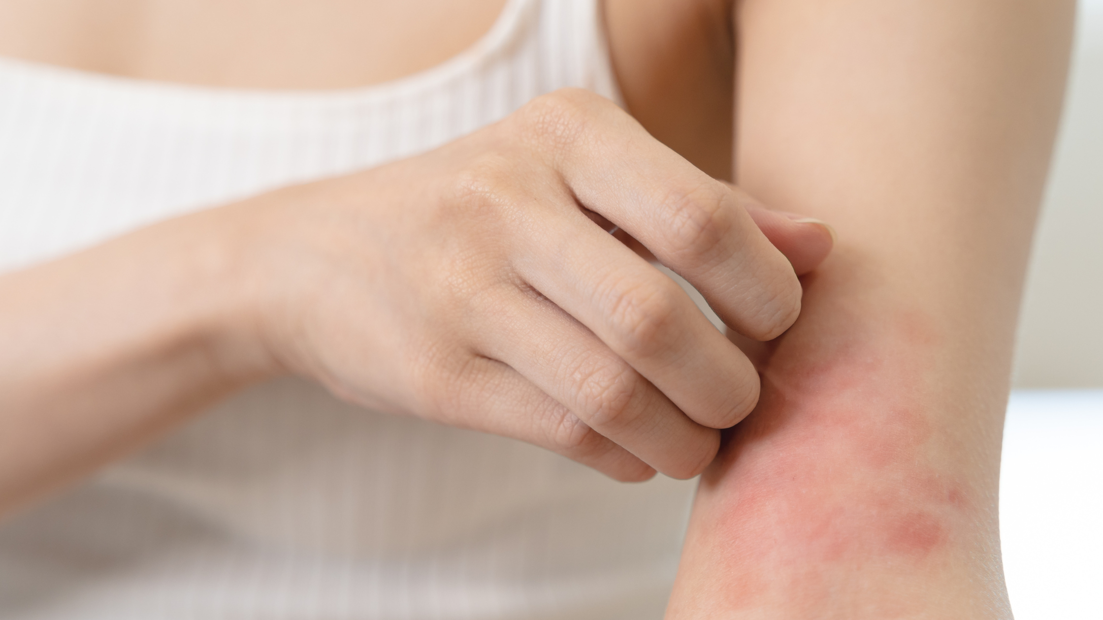 Natural and Home Remedies for Eczema Flare-Ups: What Works and What Doesn’t